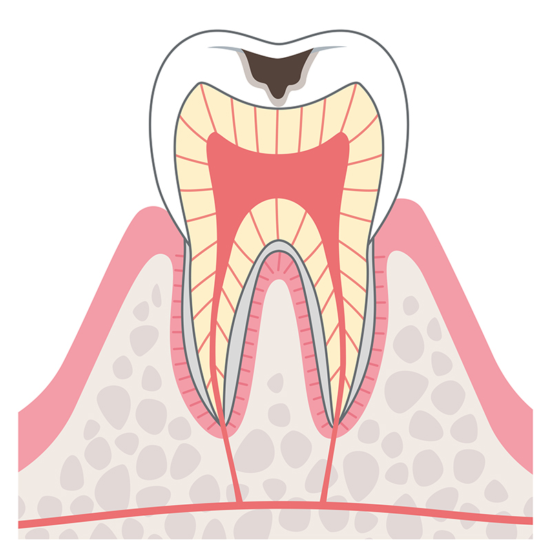 段階C2＝象牙質のむし歯の症状・治療