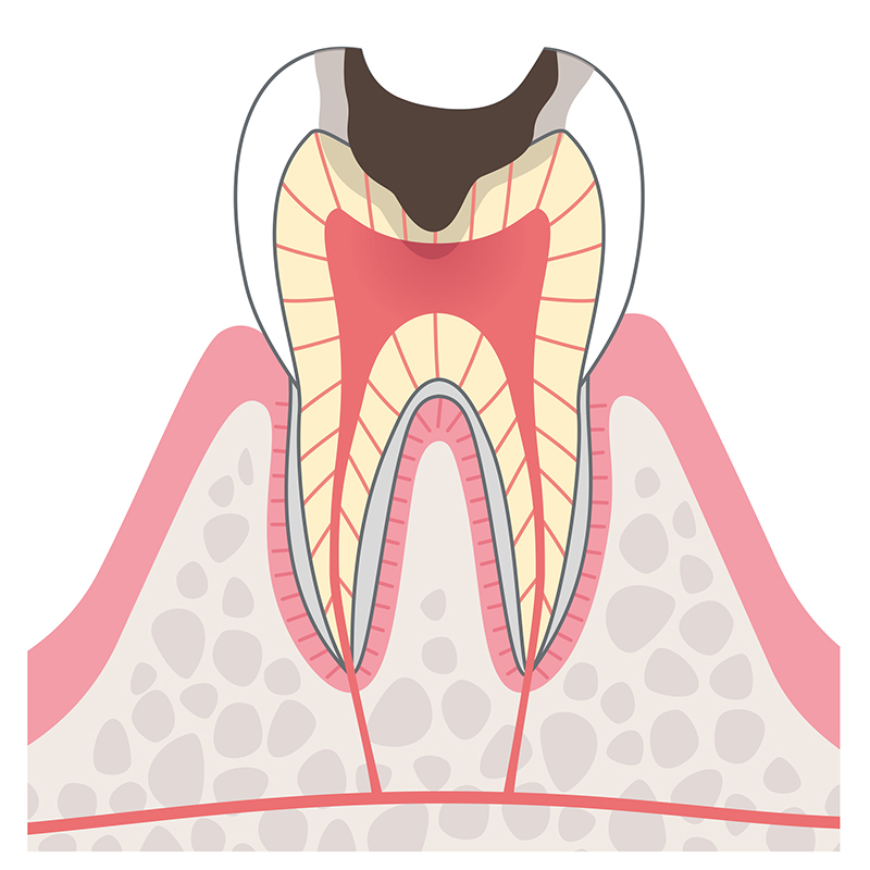 段階C3＝神経まで達したむし歯の症状・治療