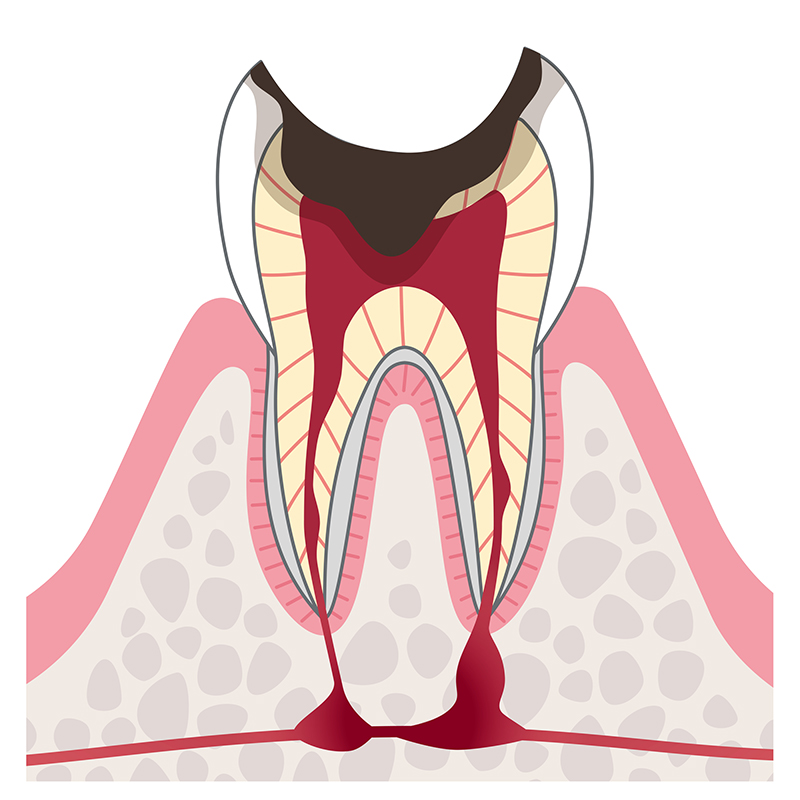 段階C4＝歯根まで浸食したむし歯の症状・治療