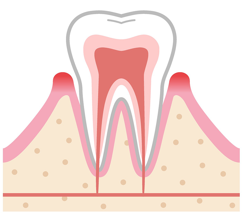 軽度の歯周病