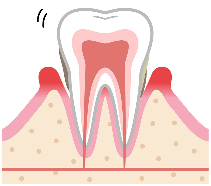 中等度の歯周病