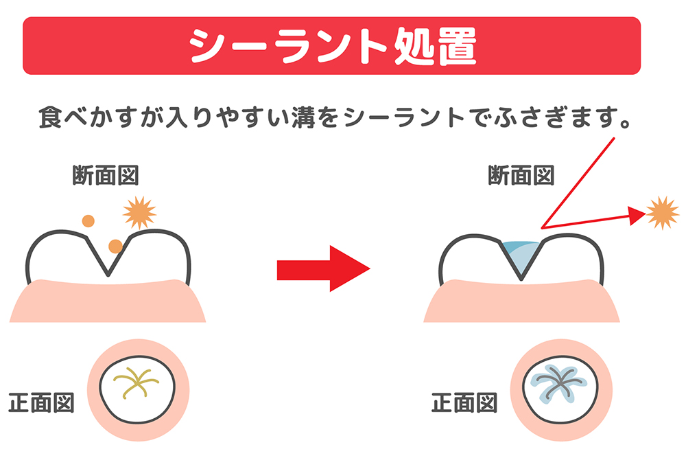 シーラントでケアを簡単に